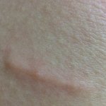 [극혐주의] 나 <b>다리피부</b>가 완전히 뒤집힘