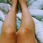 [조언부탁요] 이유를 알수없는 두드러기 (혐짤주의)