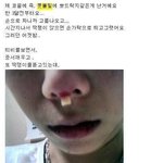 [혐 주의] 코 성형 <b>실패</b>.jpg