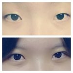 [댓글부탁해] 쌍수 <b>재수술</b>할까요?
