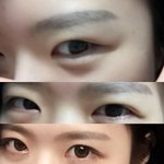 쌍수 한지 5년 됨