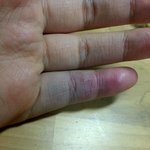 [방탈죄송] 약혐)엄마한테 맞았는데 손가락 멍이 너무 심해요