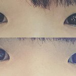 [댓글부탁해] [사진있음] 쌍수 후기같은 후기아닌 후기인 글