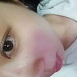 [댓글부탁해] 오늘 부분절개+<b>눈매</b>교정했는데 붓기가!!!