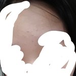 사진있)이마 <b>좁쌀</b>여드름 심해?