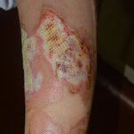 [꼭조언부탁] <사진주의>(추가)화상치료만 7개월째..