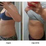 저 지방<b>흡입</b>했어요 어떤가요? 