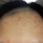(극혐주의)여드름<b>자국</b> 어떡해ㅜㅜ