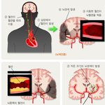 [건강] ** 3대 ‘성인병’, 당뇨, <b>뇌졸중</b>, 심장질환을 경계하라**