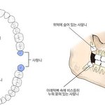 [건강] ** ‘사랑니’, 무조건 빼야 할까? **