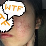 [댓글부탁해] 여드름 때문에 진짜 미치겠다(여드름사진 주의)