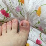 [조언부탁해] (혐짤주의)  나 내성<b>발톱</b> 존나심한대 수술해야되냐...