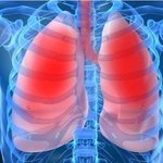 [건강] **‘폐암’ 어떻게 막을 것인가!!  소리 없이 번지는...