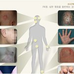 [건강] **지긋지긋한 <b>무좀</b>!  가을에는 반드시 치료한다!**
