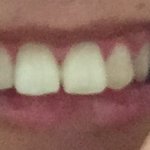 얘들아 나 교정 빨리해야겠지..