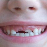 [건강] **‘치아 <b>소실</b>’에 대처하는 법**