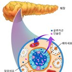 [건강] ** ‘제1형 당뇨병’ 에 맞서기 **