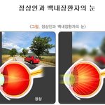 [건강] ** ‘<b>백내장</b>’ 치료, 더 이상 미루지 마라! **