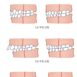 [건강] ** 양악수술!  ‘돌출 입’의 교정 치료와 수술 **