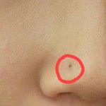 [댓글부탁해] 코 <b>뾰루지</b>?잘못짜서 이렇게됬는데