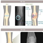 [건강] ** 겨울철 <b>불청객</b> ‘골관절염’예방하기 **