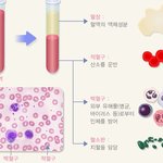 [건강] ** ‘만성 특발성 혈소판 감소성 자반증’ 이란 무엇일까...