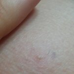 무릎에 노란색 <b>고름</b> ?..