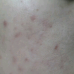 [피부관리] 여드름피부에게 한줄기 빛를 주겟음