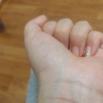붉은<b>흉터</b>사라질까요?