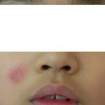 [댓글부탁해] 내 동생 아토피인데 어떻게 하면 빨리 나을 수 있음...