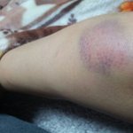 [방탄소년단] 남준이 병원간거 잘한듯