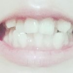 교정<b>전후</b>