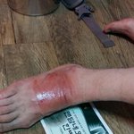 이모부가 <b>파스</b>때문에 화상을 당하셨는데..