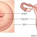 [건강상식] ** ‘자궁경부암’, 예방에서 대처까지**