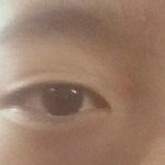 [댓글부탁해] 쌍커<b>풀</b> 수술 해야되나...?