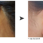 레이저로 탄<b>생식</b>피어싱한 후기!