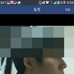 <b>무턱</b> 차이 나나요??
