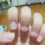 <b>손톱</b> 물어뜯는 거 고쳤어요