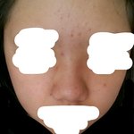 [댓글부탁해] 또)추가)사진있음)피부 많이 좋아졌지?