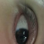[댓글부탁해] <b>쌍수</b>오늘했는데 ㅠㅠ