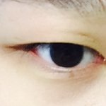 쌍수후기 !!!! .... 성공적