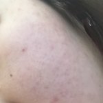 [드루와] <b>피부때</b>매 진짜 스트레스다..