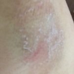 [꼭조언부탁] 왁<b>싱</b> 부작용 (사진O)