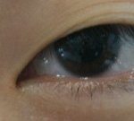 쌍커풀<b>절개</b> 수술 너무 잘돼서 너무 행복해요 ㅠㅠㅠ