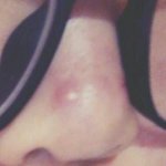 [조언부탁해] <b>코에</b> 여드름 존나 큰거 났어;;