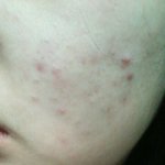[조언부탁해] (<b>사진주</b>의)여드름 관리법좀 알려주세요ㅠ