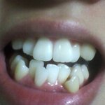 교정<b>전후</b>사진올려봐여