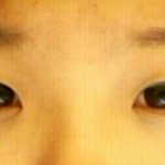 코 <b>필러</b> 