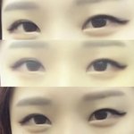 쌍수 재수술 고민....ㅠㅠ