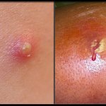 [남자뷰티팁] 좁쌀여드름 화농성여드름 자주나는 남자들을 위한 깨알팁(1)